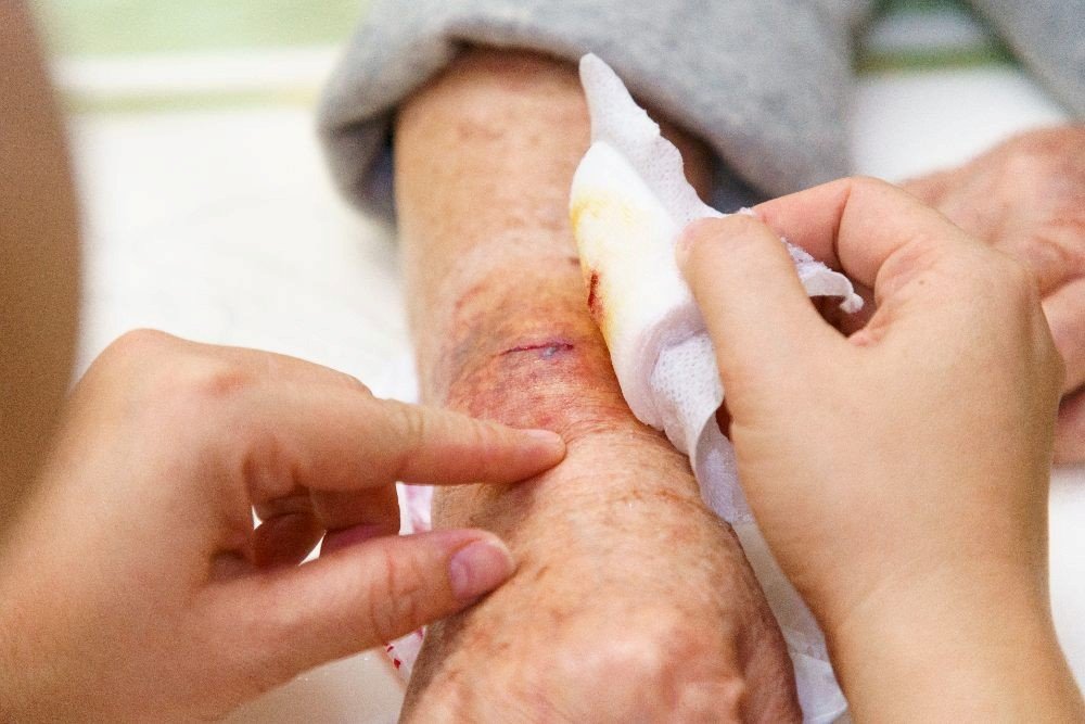 Radiation-Induced Wound Healing Treatment on Lower Leg in Dallas & Mansfield, TX